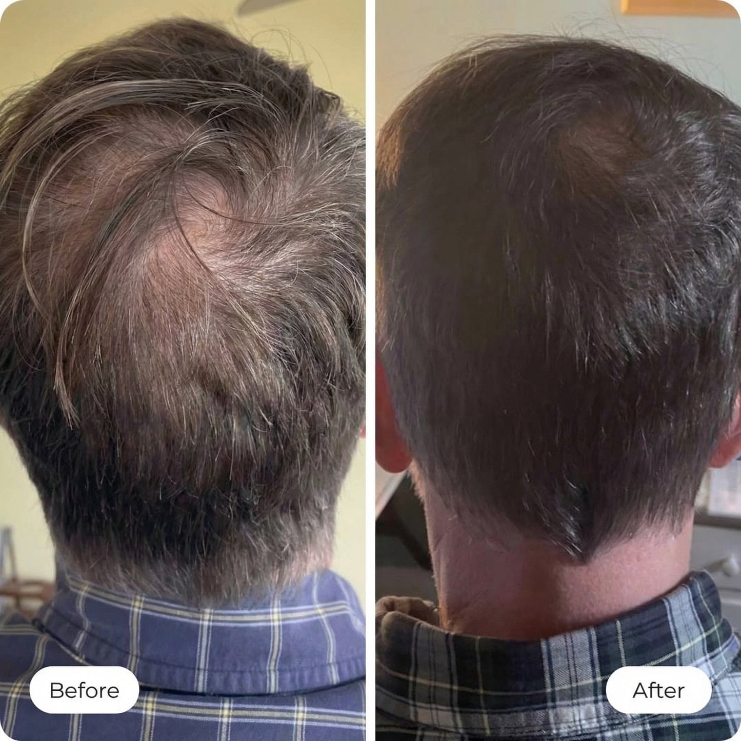 Haluna 2.0™ Revival Scalp Infusion Therapy Comb